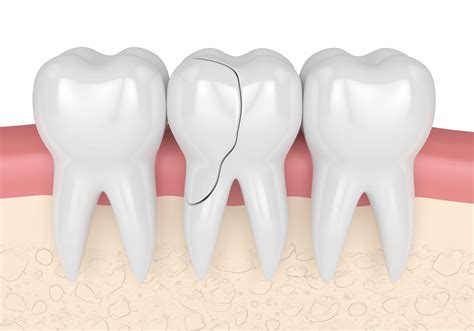 Common landmarks 1 Right upper wisdom. . Cracked tooth root infection